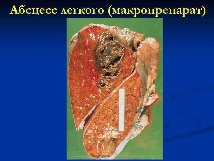 Абсцесс легкого (макропрепарат) 