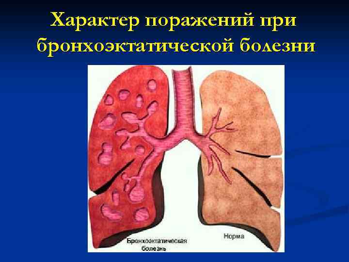 Характер поражений при бронхоэктатической болезни 