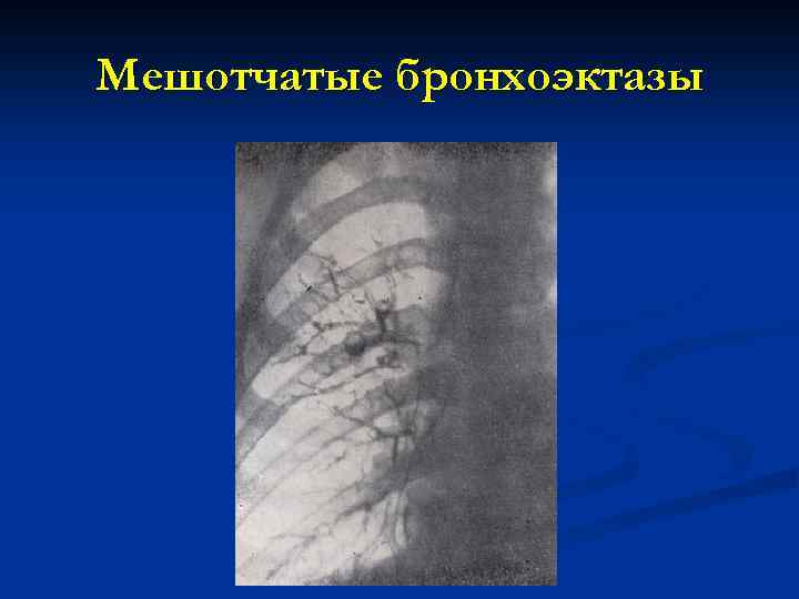Мешотчатые бронхоэктазы 
