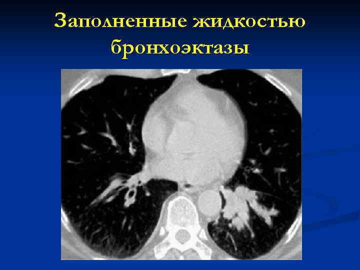 Заполненные жидкостью бронхоэктазы 