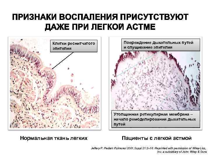 Клетки реснитчатого эпителия Повреждение дыхательных путей и слущивание эпителия Утолщенная ретикулярная мембрана – начало