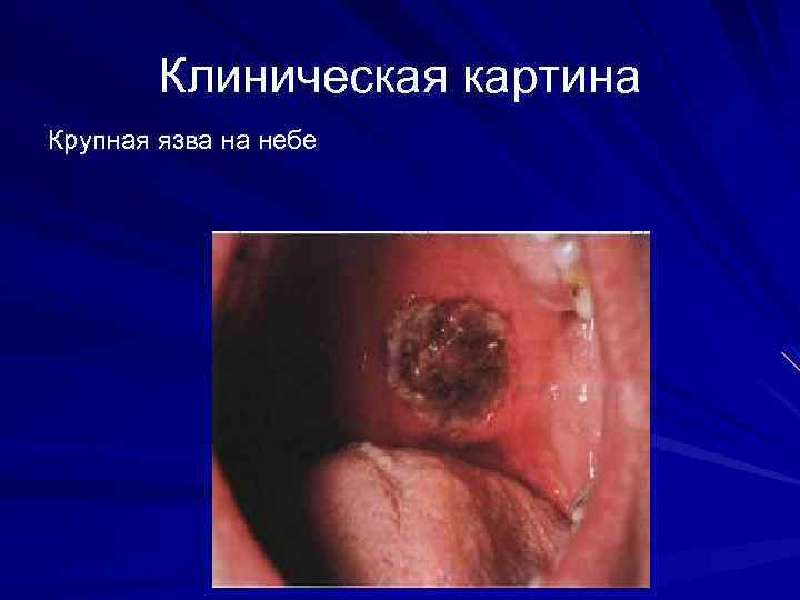 Клиническая картина Крупная язва на небе 