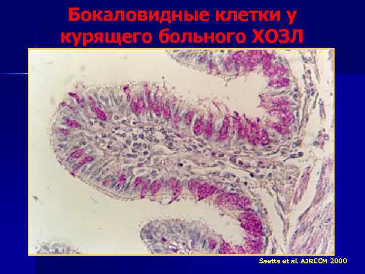Бокаловидные клетки у курящего больного ХОЗЛ Saetta et al. AJRCCM 2000 