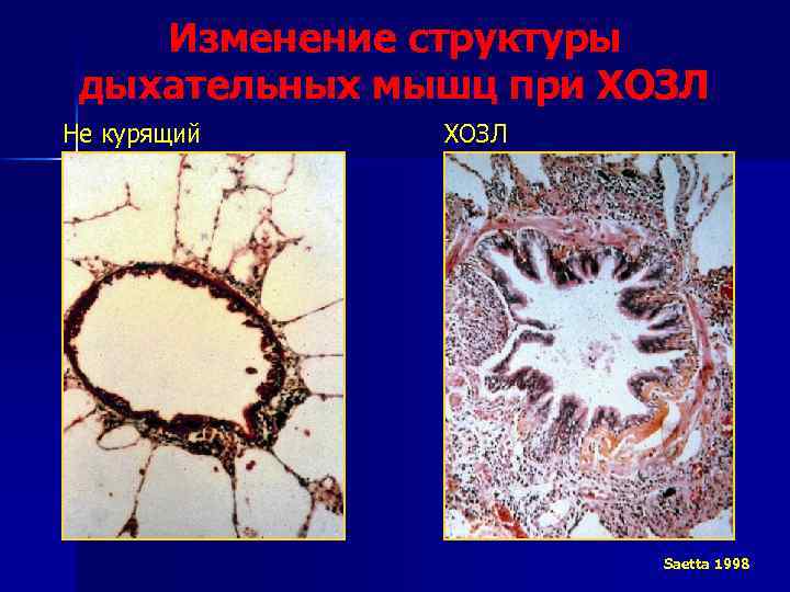 Изменение структуры дыхательных мышц при ХОЗЛ Не курящий ХОЗЛ Saetta 1998 