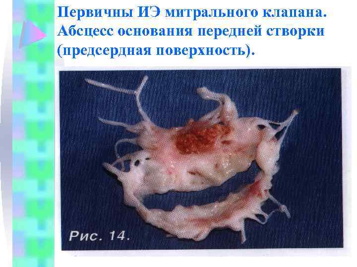 Первичны ИЭ митрального клапана. Абсцесс основания передней створки (предсердная поверхность). 