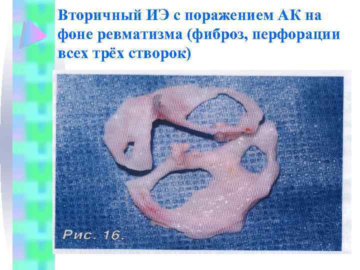 Вторичный ИЭ с поражением АК на фоне ревматизма (фиброз, перфорации всех трёх створок) 