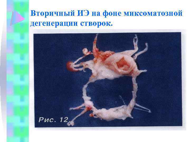 Вторичный ИЭ на фоне миксоматозной дегенерации створок. 