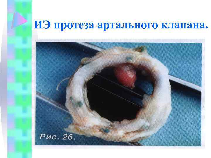 ИЭ протеза артального клапана. 