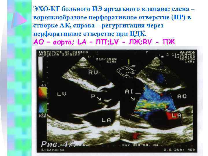 ЭХО-КГ больного ИЭ артального клапана: слева – воронкообразное перфоративное отверстие (ПР) в створке АК,