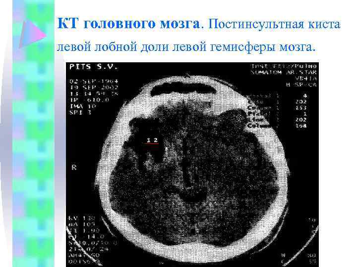 КТ головного мозга. Постинсультная киста левой лобной доли левой гемисферы мозга. 