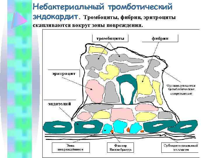 Небактериальный тромботический эндокардит. Тромбоциты, фибрин, эритроциты скапливаются вокруг зоны повреждения. 