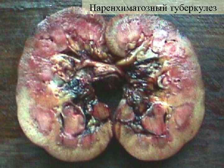 Паренхиматозный туберкулез 
