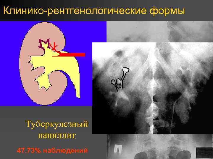 Для рентгенологической картины туберкулеза почки характерна