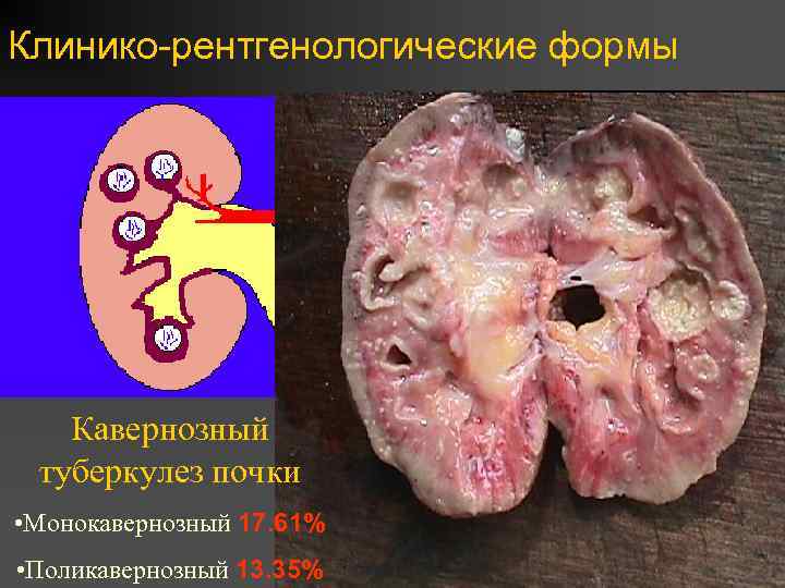 Клинико-рентгенологические формы Кавернозный туберкулез почки • Монокавернозный 17. 61% • Поликавернозный 13. 35% 