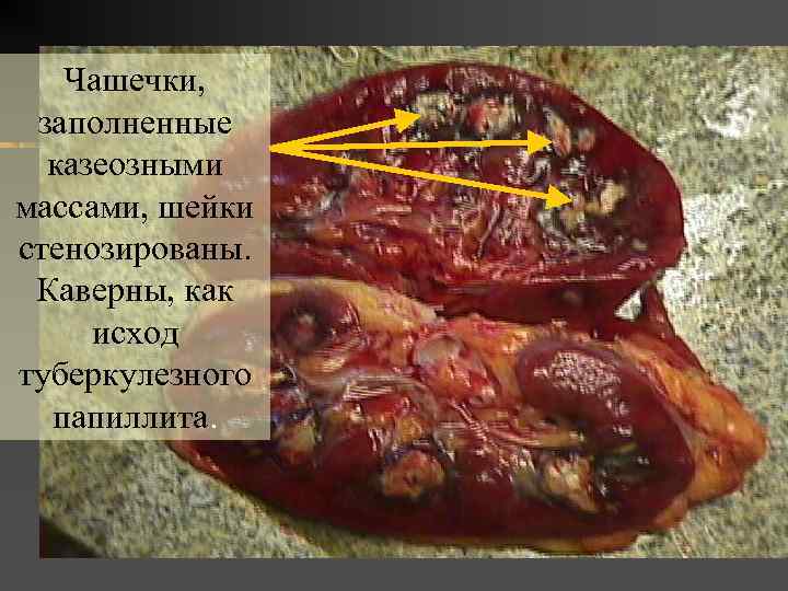 Чашечки, заполненные казеозными массами, шейки стенозированы. Каверны, как исход туберкулезного папиллита. 