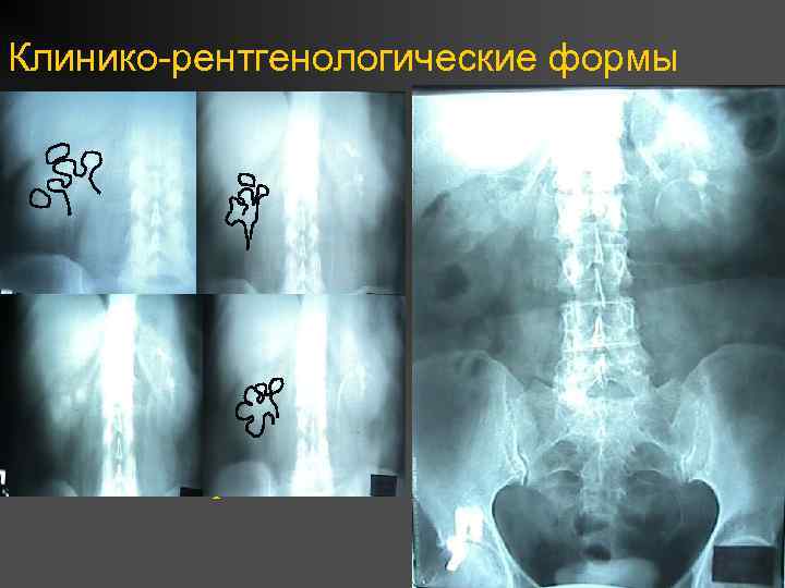 Клинико-рентгенологические формы Паренхиматозная каверна 