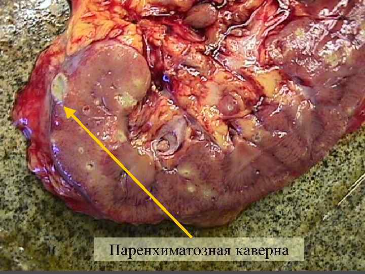 Паренхиматозная каверна 