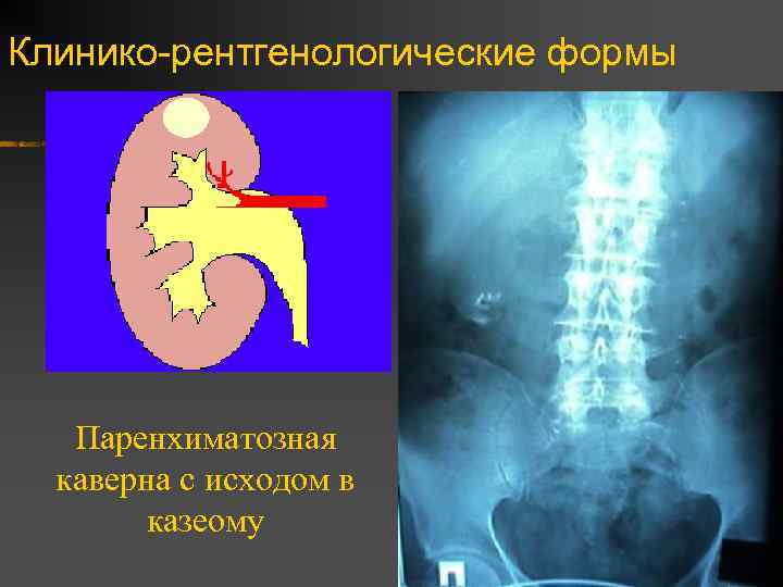 Клинико-рентгенологические формы Паренхиматозная каверна с исходом в казеому 