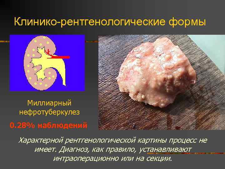 Клинико-рентгенологические формы Миллиарный нефротуберкулез 0. 28% наблюдений Характерной рентгенологической картины процесс не имеет. Диагноз,