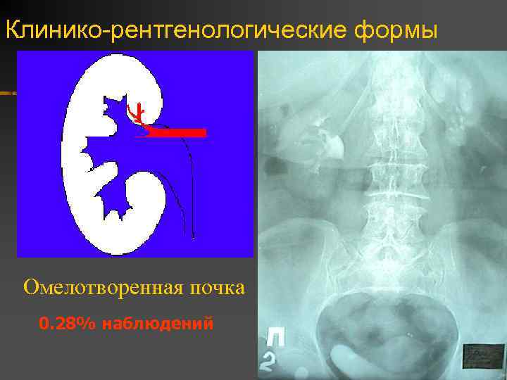 Клинико-рентгенологические формы Омелотворенная почка 0. 28% наблюдений 