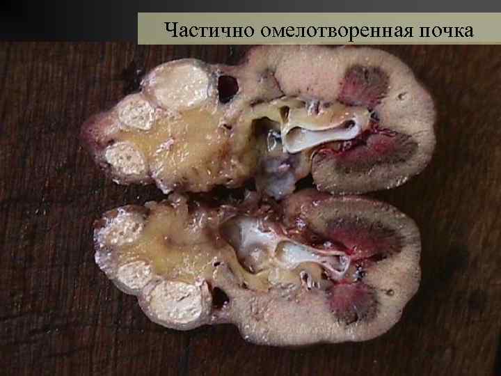 Частично омелотворенная почка 