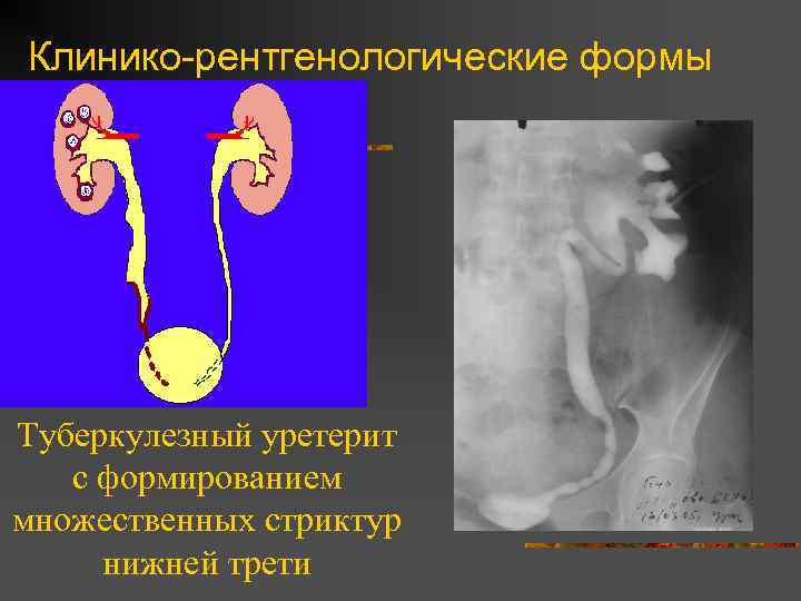 Клинико-рентгенологические формы Туберкулезный уретерит с формированием множественных стриктур нижней трети 