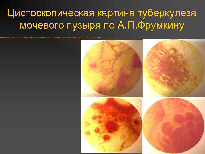 Цистоскопическая картина туберкулеза мочевого пузыря по А. П. Фрумкину 