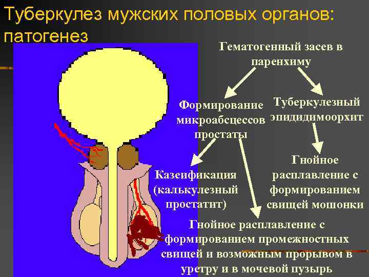 Туберкулез мужских половых органов: патогенез Гематогенный засев в паренхиму Формирование Туберкулезный микроабсцессов эпидидимоорхит простаты