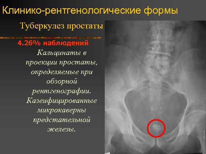 Клинико-рентгенологические формы Туберкулез простаты 4. 26% наблюдений Кальцинаты в проекции простаты, определяемые при обзорной