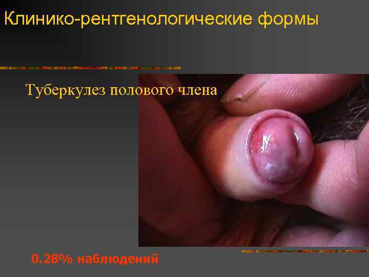 Клинико-рентгенологические формы Туберкулез полового члена 0. 28% наблюдений 