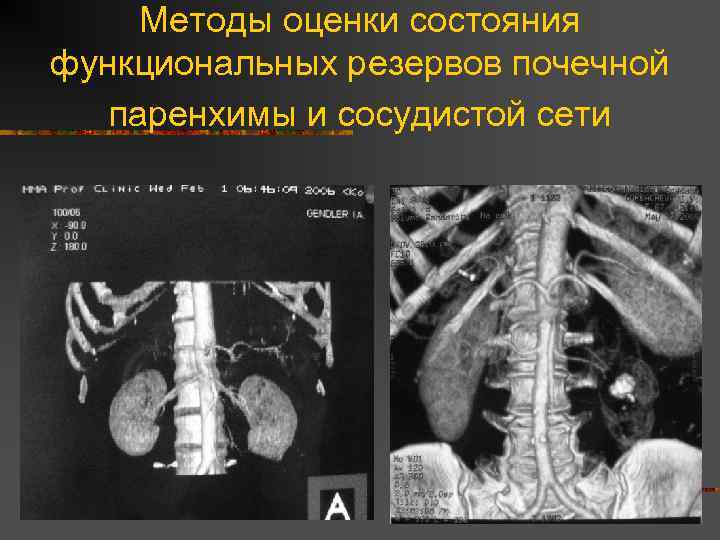 Методы оценки состояния функциональных резервов почечной паренхимы и сосудистой сети n n Нефросцинтиграфия МСКТ