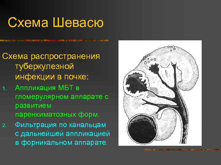 Схема Шевасю Схема распространения туберкулезной инфекции в почке: 1. 2. Аппликация МБТ в гломерулярном
