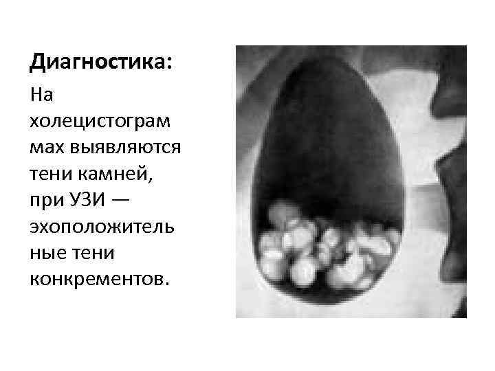 Диагностика: На холецистограм мах выявляются тени камней, при УЗИ — эхоположитель ные тени конкрементов.