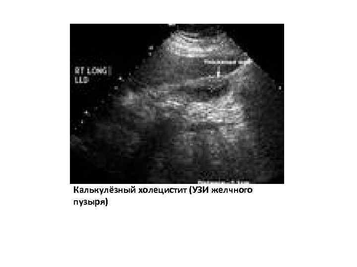 Калькулёзный холецистит (УЗИ желчного пузыря) 