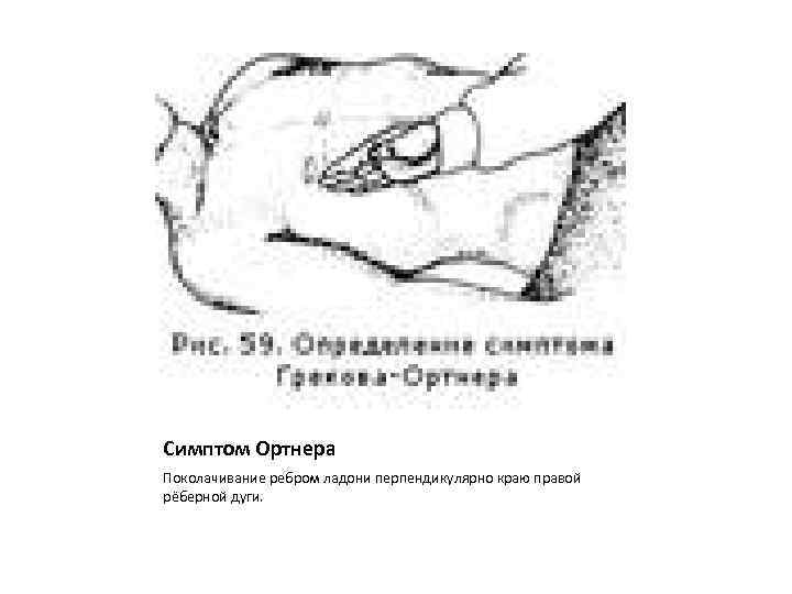 Симптом Ортнера Поколачивание ребром ладони перпендикулярно краю правой рёберной дуги. 