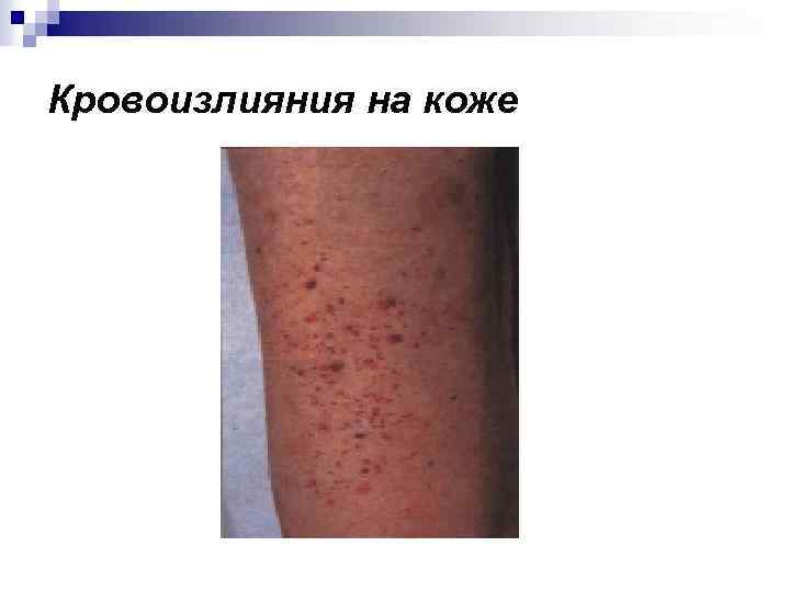 Кровоизлияния на коже 