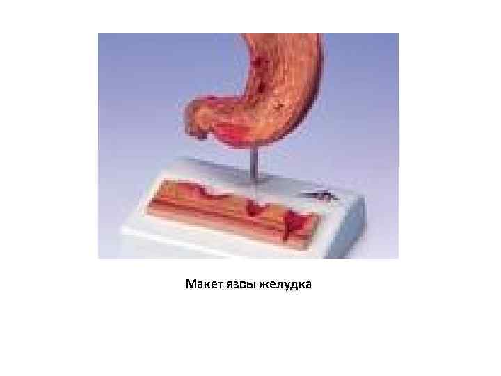 Макет язвы желудка 