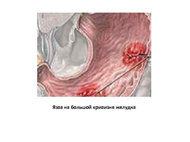 Язва на большой кривизне желудка 