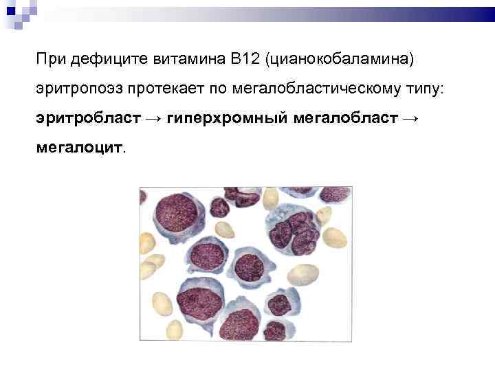 При дефиците витамина В 12 (цианокобаламина) эритропоэз протекает по мегалобластическому типу: эритробласт → гиперхромный