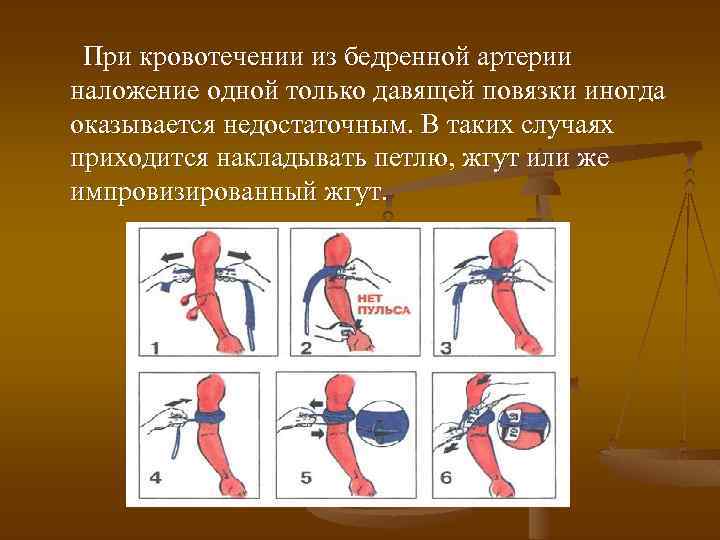 При кровотечении из бедренной артерии наложение одной только давящей повязки иногда оказывается недостаточным. В