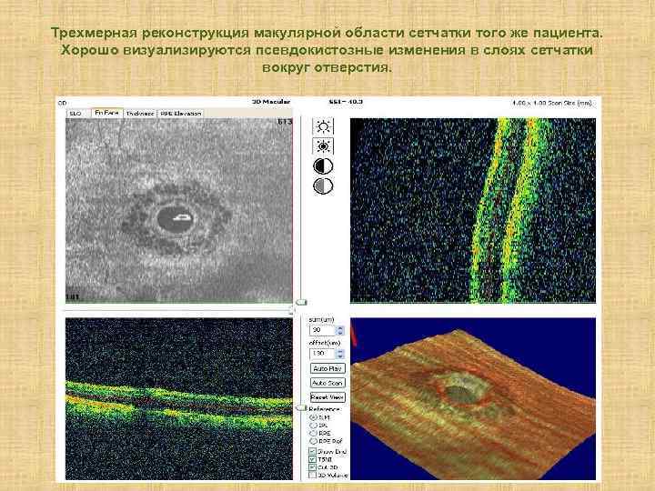 Трехмерная реконструкция макулярной области сетчатки того же пациента. Хорошо визуализируются псевдокистозные изменения в слоях