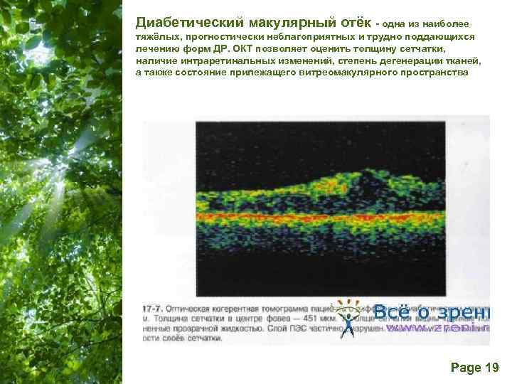 Диабетический макулярный отёк - одна из наиболее тяжёлых, прогностически неблагоприятных и трудно поддающихся лечению