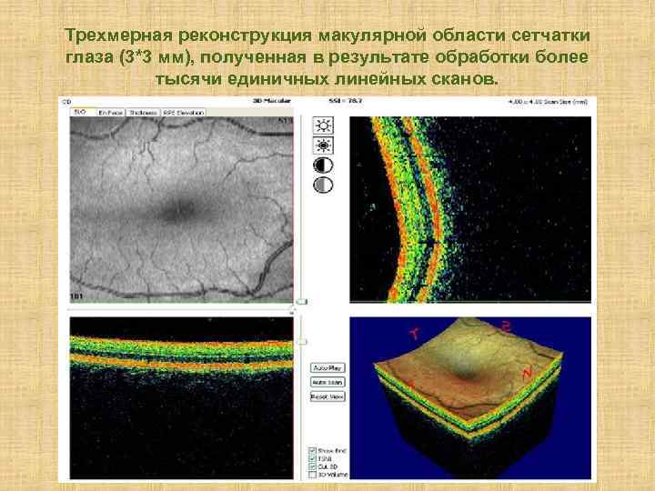 Трехмерная реконструкция макулярной области сетчатки глаза (3*3 мм), полученная в результате обработки более тысячи