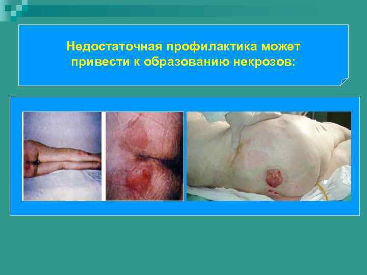 Недостаточная профилактика может привести к образованию некрозов: 