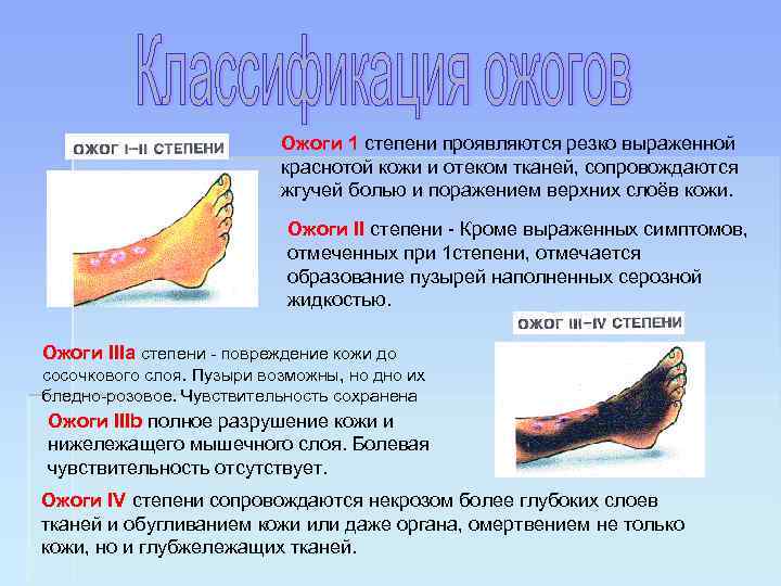 Ожоги 1 степени проявляются резко выраженной краснотой кожи и отеком тканей, сопровождаются жгучей болью