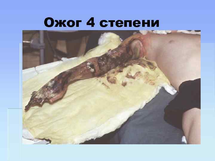 Ожог 4 степени 