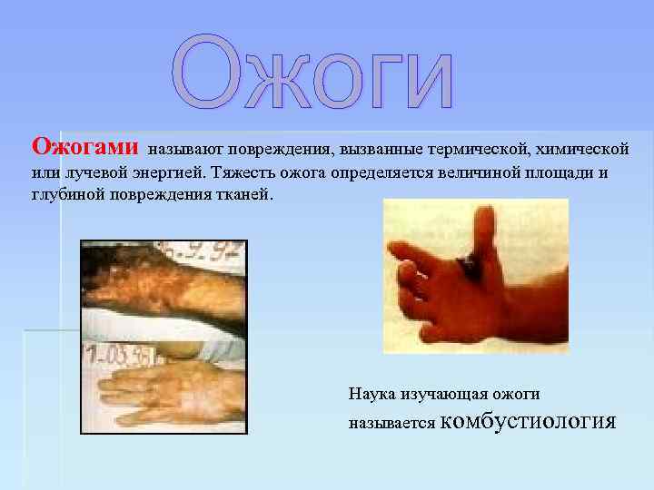 Ожогами называют повреждения, вызванные термической, химической или лучевой энергией. Тяжесть ожога определяется величиной площади