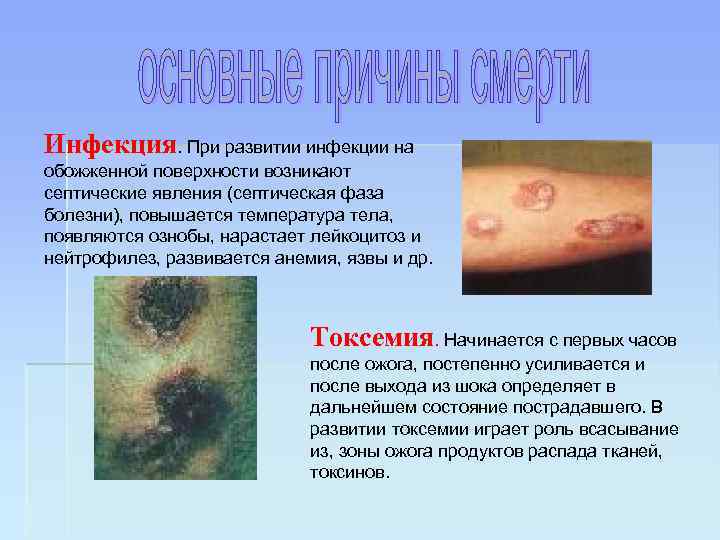 Инфекция. При развитии инфекции на обожженной поверхности возникают септические явления (септическая фаза болезни), повышается