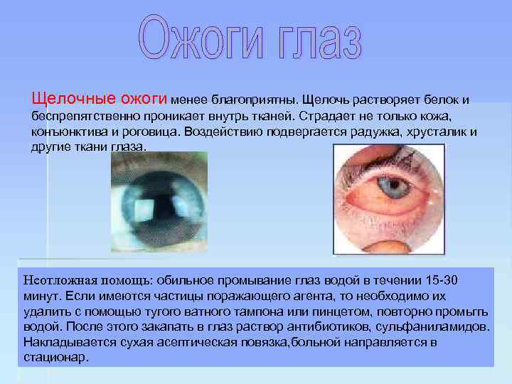 Щелочные ожоги менее благоприятны. Щелочь растворяет белок и беспрепятственно проникает внутрь тканей. Страдает не