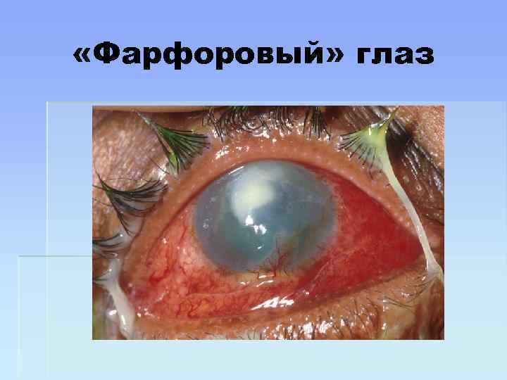  «Фарфоровый» глаз 